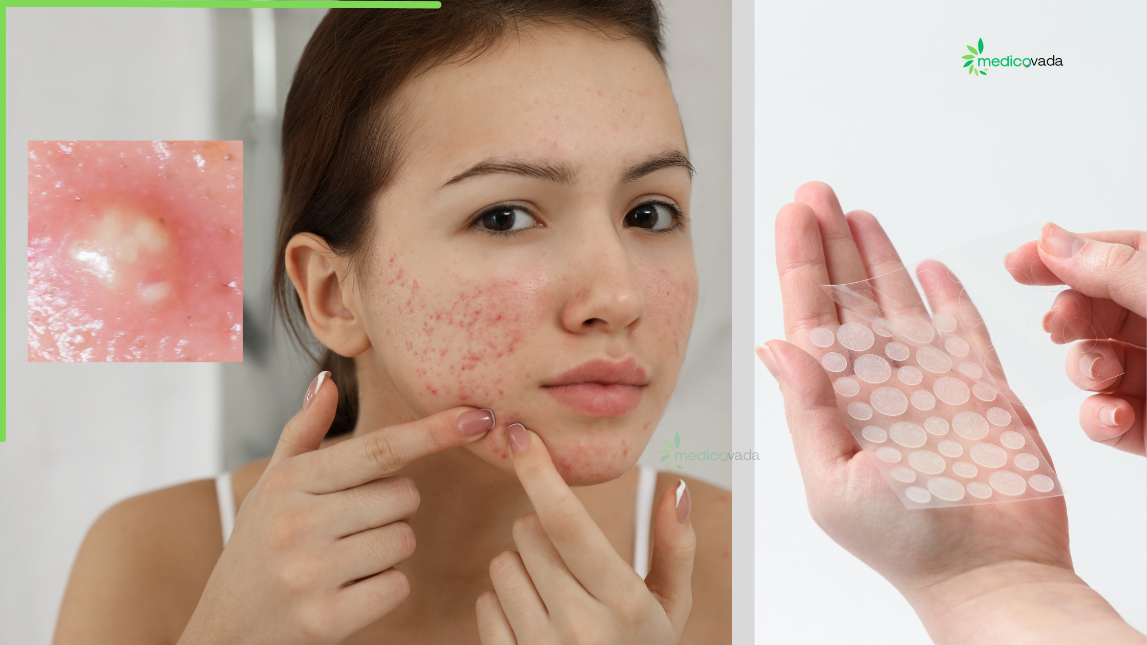 How Can I Remove Pimple at Home?